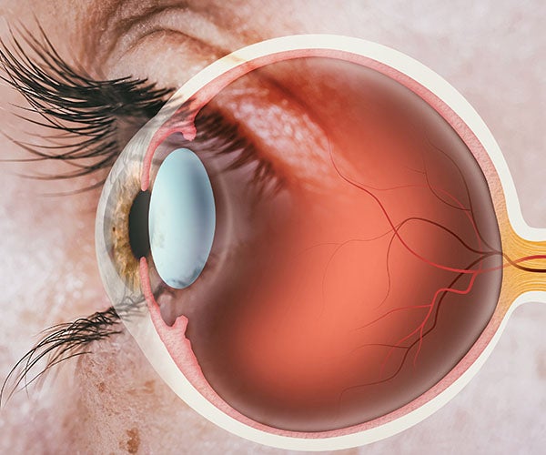 wet macular degeneration thumbnail
