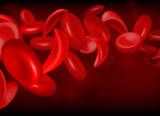 Sickle Cell Disease